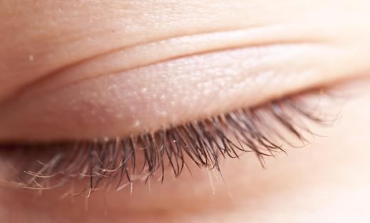 A bacterial infection in the eyelid and eyelash area can cause blepharitis.