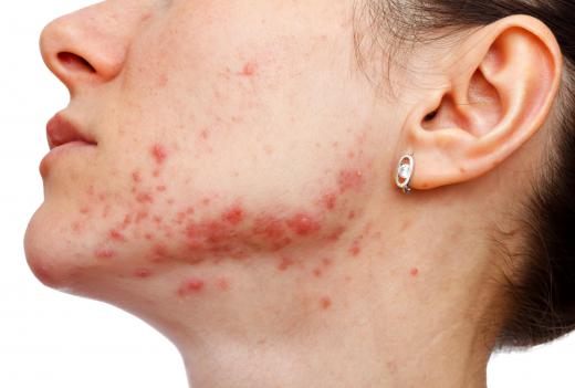 Clindamycin hydrochloride might be used to treat acne.