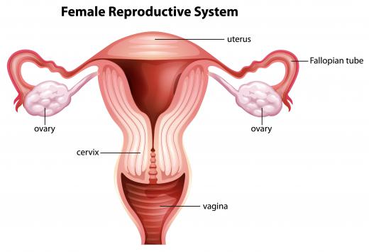 Endometriosis, or uterine tissue growing outside the uterus, can cause cramps after a woman's period.