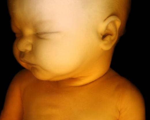 Betamethasone could pose a problem to the development of a fetus.