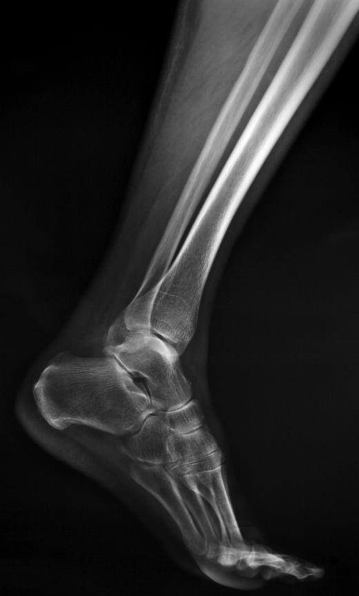 The lateral ankle ligament connects the fibula to bones in the foot.