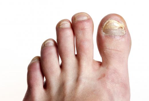 Uropathy has been used to treat nail fungus.