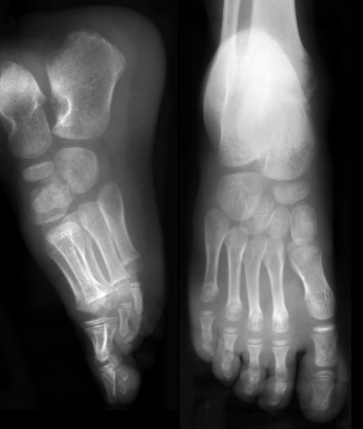 A break in the cuboid bone may not show up on an x-ray.