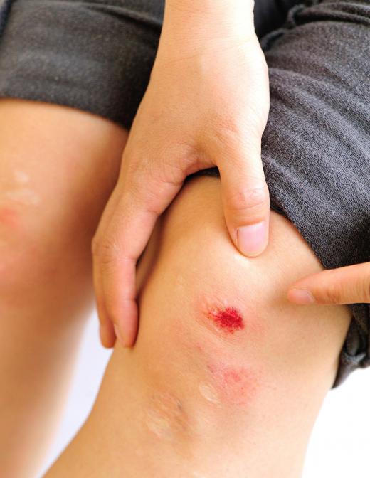 Healing ointments can prevent infections from developing in wounds.