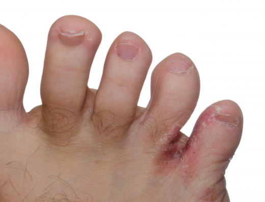 A fungal infection causes athlete's foot.