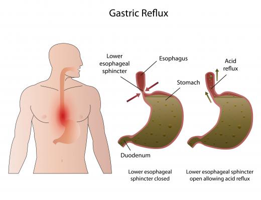 A hiatal hernia may cause GERD.