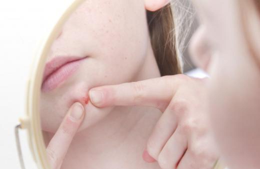 The best acne treatment depends on how severe the person's condition is.