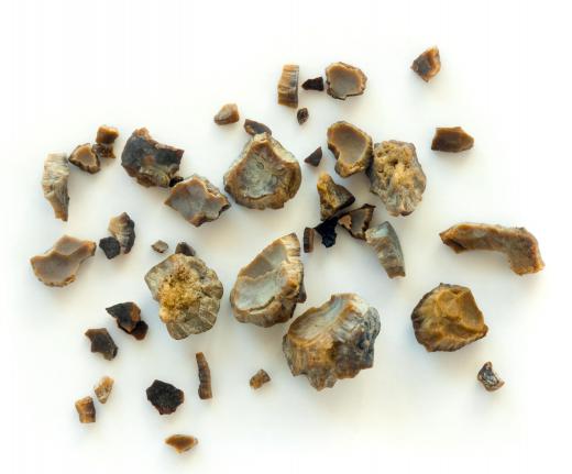 Kidney stones, including calcium oxalate crystals, form when there are imbalances in a patient's blood and urine chemistry.