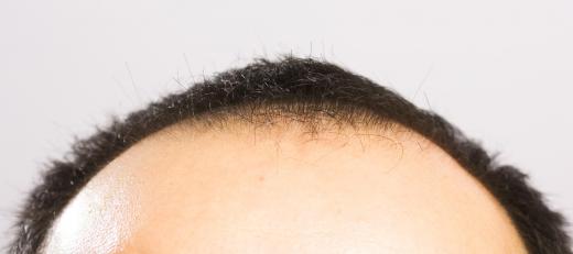 Hairline acne refers to blackheads and pimple that form around the hairline.