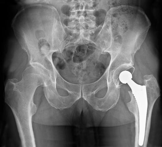 An X-ray of the pelvic area, showing a metal replacement hip.