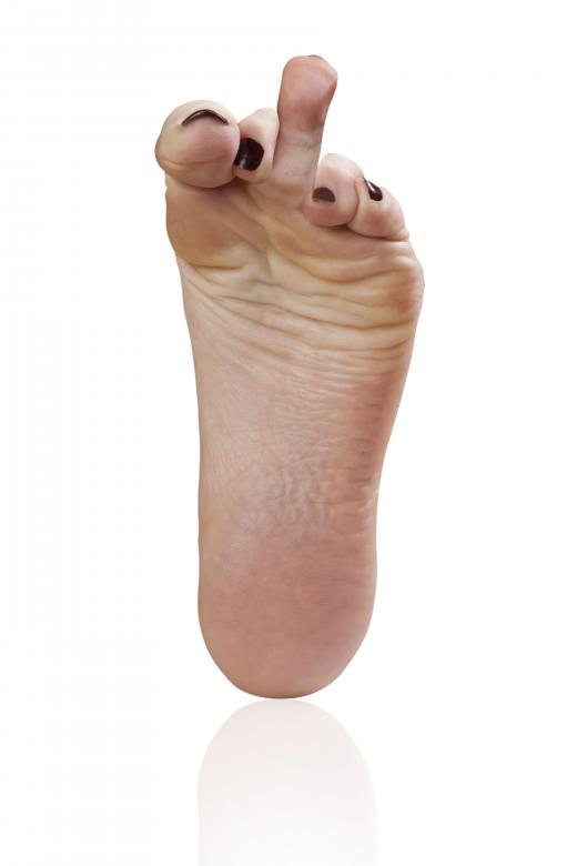 A foot deformity may occur on any part of the foot.