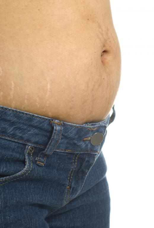 Alcohol consumption often leads to bloating, and this transforms to belly fat.