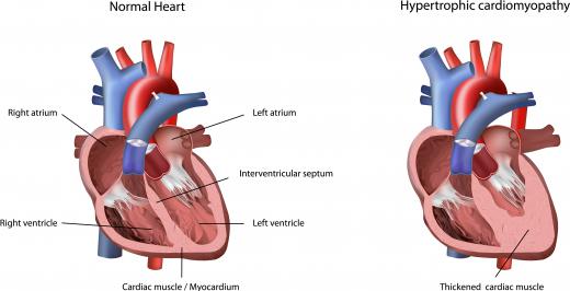 Hypertrophic cardiomyopathy is a heart condition where the walls of the heart have become thickened, making it difficult for the heart to pump efficiently.