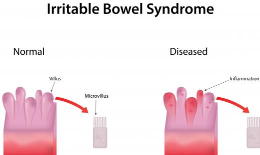 Patients who suffer with irritable bowel syndrome may suffer from gastropathy-type symptoms.