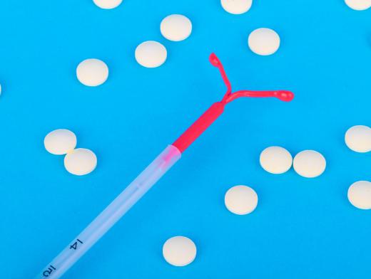 A form of birth control, an intrauterine device (IUD) delivers the hormone progestin to the uterus.