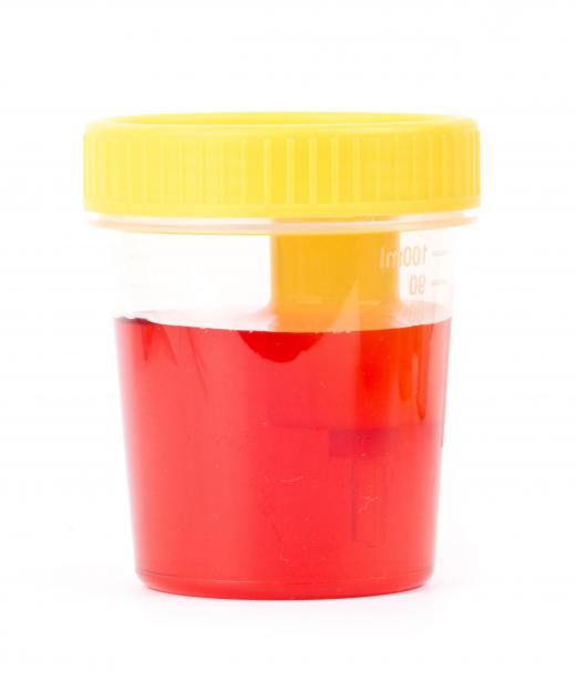 Urine that appears bloody may point to a nephritis diagnosis.