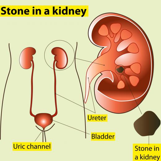 A kidney with a kidney stone.