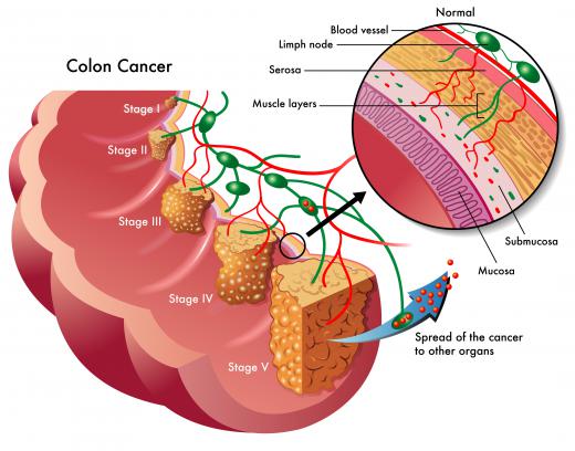 Bevacizumab may be used to treat colon cancer that has metastasized.