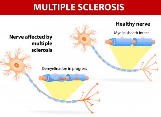 Akinetic mutism may be caused by multiple sclerosis.