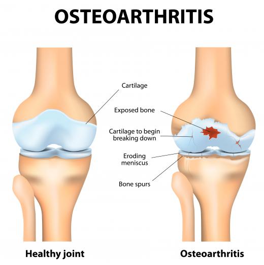 A knee replacement may be recommended if a patient has advanced osteoarthritis of the joint.