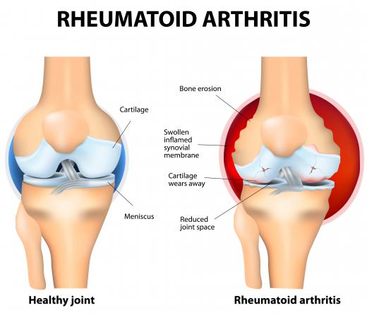 Electrical stimulation therapy can help treat the localized pain caused by rheumatoid arthritis.