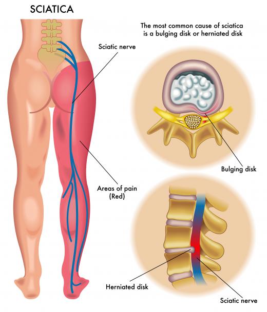 If the sciatic nerve becomes irritated, it can cause neuralgia -- or pain and numbness -- down the leg.