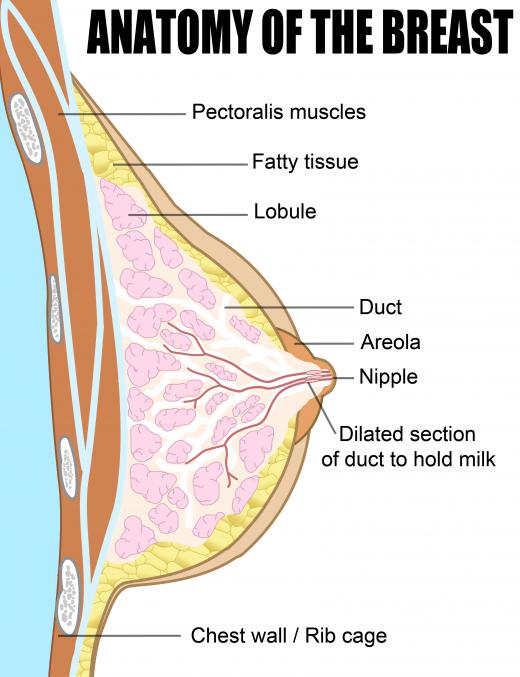 The clogging of a milk duct can cause breast calcification.