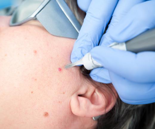 Laser surgery can be used for keloid scar treatment.