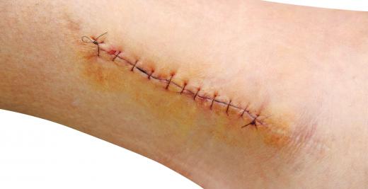 Open wounds that require stitches should be handled by a doctor as soon as possible.