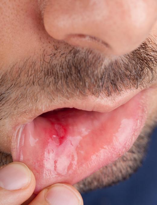 Some harsher toothpastes can lead to canker sores.