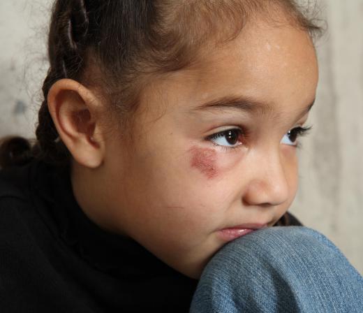 Child abuse refers to harm that is done to a minor, be it physical, mental, verbal or emotional.