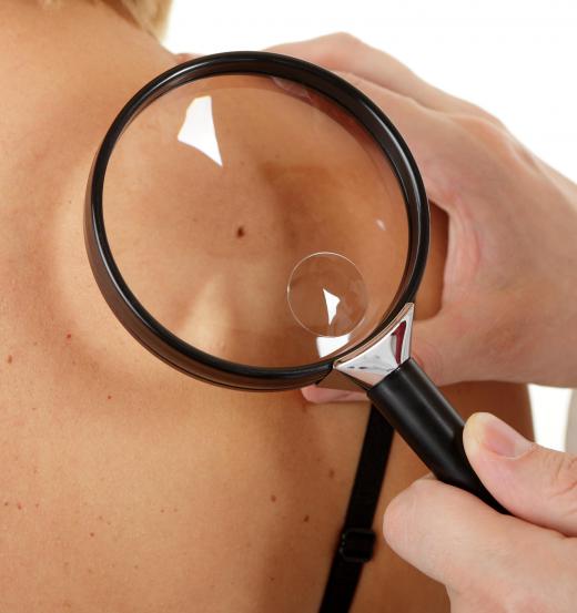 Squamous cell skin cancer often appears as a rough, raised, and possibily discolored spot on the skin.