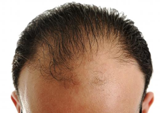 A man starting to lose his hair in the front.