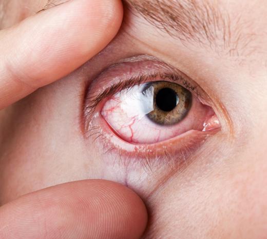 A dysfunctional meibomian gland may cause dry eyes.