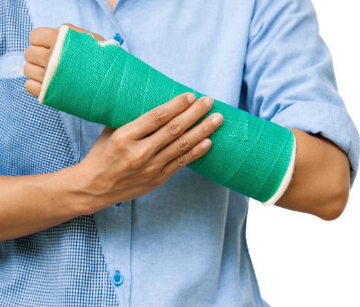 Depending on the severity of the break, a person may have to get a hard plaster cast on their wrist.