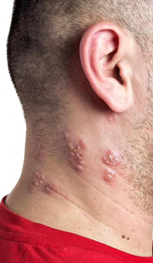 Shingles is characterized by blisters and a rash, which usually appear on one side of the face or on the upper torso.