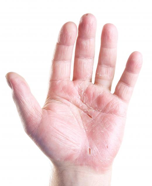 Moisturizing hand lotion can be used to treat dry, cracked hands.