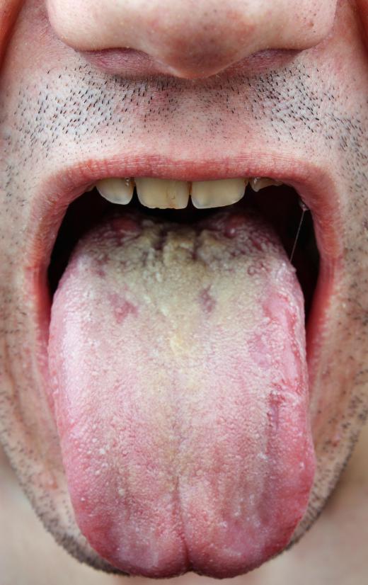 Oral sex during a yeast infection can lead to an oral infection called thrush.