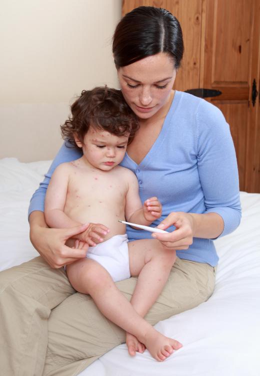 Toddlers may have a mild rash after contracting chickenpox.