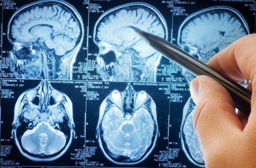 Stereotactic radiotherapy is most often used on metastatic brain cancer.