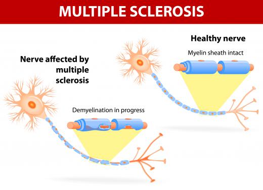 Multiple sclerosis is a disorder that arises when an individual's immune system attacks the myelin sheaths surrounding axons in the central nervous system.