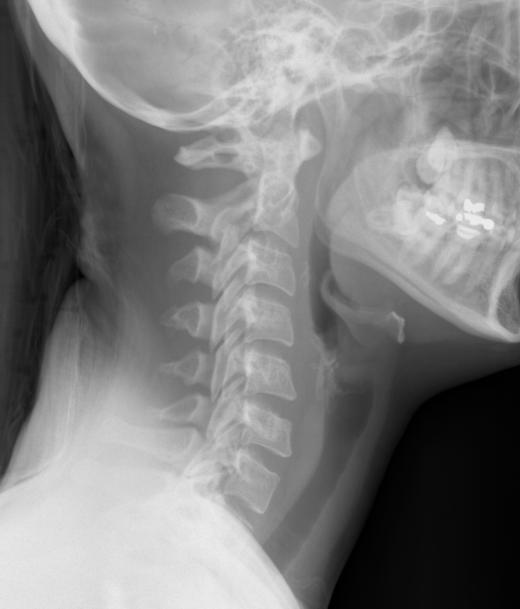 An X-ray of the neck, including vertebrae.