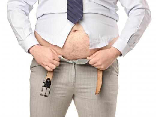 Patients must have a high BMI, or obesity related health complications, in order to qualify for a duodenal switch.