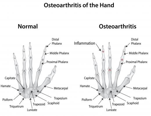 Osteoarthritis may cause erythema annulare centrifugum in some individuals.