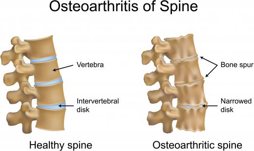 An illustration of a healthy spine and one with spinal osteoarthritis, one cause of back pain.