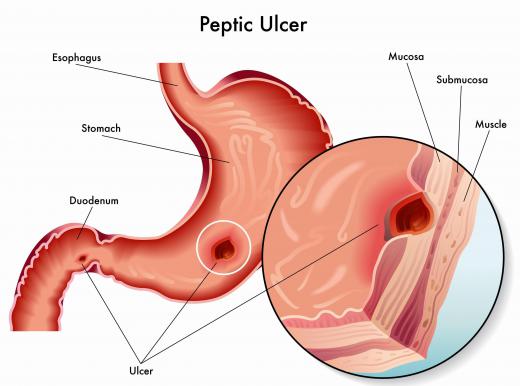 An antrectomy may be performed on a person whose peptic ulcer does not respond to medications.