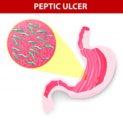 Intestinal blockage occurs in 5-8% of people with peptic ulcer complications.