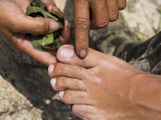 Some forms of rhubarb root can be used to treat gout.