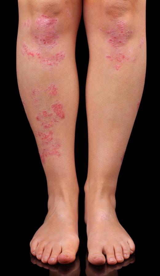 Fumarate has been shown to improve the skin of those with psoriasis.