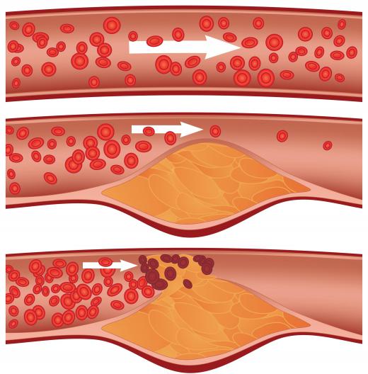 An arterial graft may be necessary due to the buildup of plaque that narrows arteries.